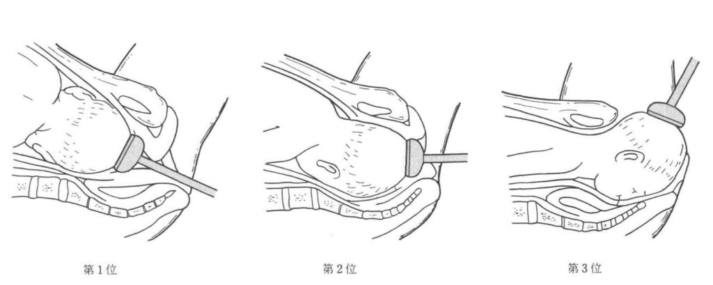 吸引分娩 Vacuum Extraction ゆきぞらブログ